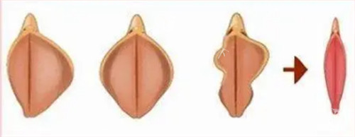 阴唇整形前后对比图