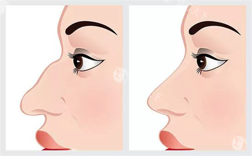 驼峰鼻鼻部矫正对比