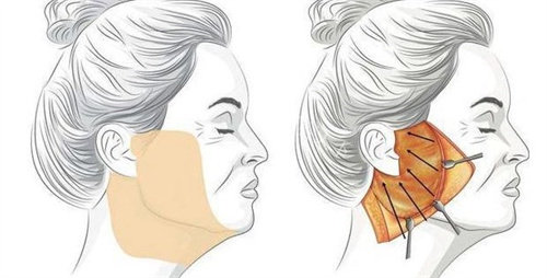 拉皮手术风险预警！神经损伤等5大并发症避坑指南，如何筛选靠谱医生？