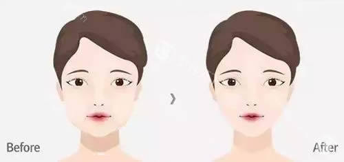 面部轮廓整形前后对比图
