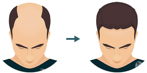 植发前后对比图