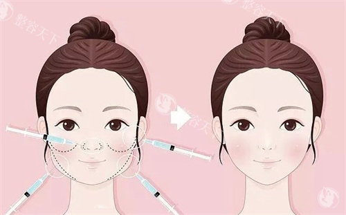 轻薄针真能消除馒化脸吗？揭秘轻薄针原理、结果、适用人群及与其他瘦脸方法大对比