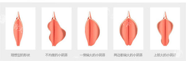 不同阴唇形状情况照片