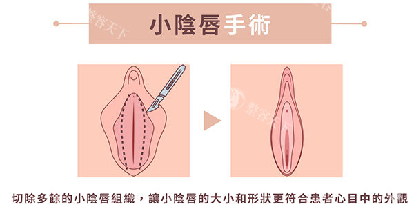 小阴唇整形手术前后照片