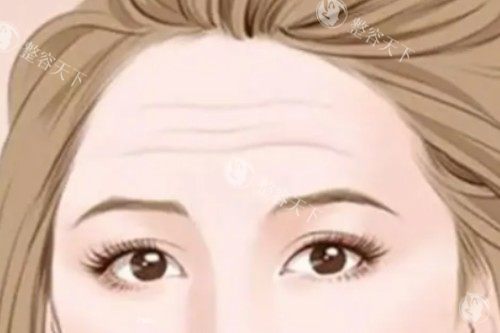 想去除抬头纹又怕花冤枉钱？抬头纹去除手术费用大揭秘，这些因素你得知道！
