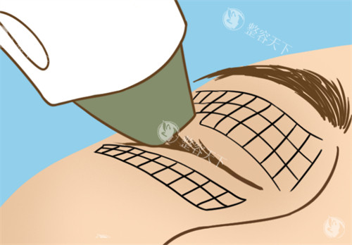 想知道五代热玛吉900发的具体价格吗？快来了解地域、医院、皮肤状况等因素如何影响收费！