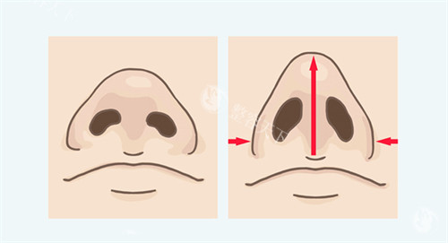 鼻翼缩后鼻子挺拔