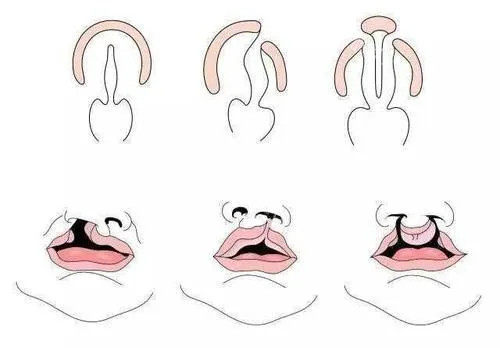 广州高尚余文林做唇裂二次修复怎么样？20余年临床经验技术在线