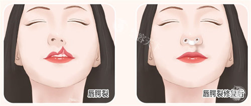 唇腭裂修复