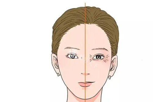 祛眼纹打胶原蛋白成效明显不？听听做过的人怎么说！