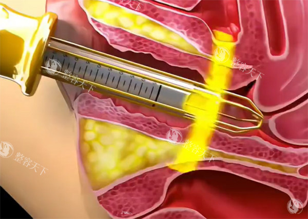 紧缩针紧缩推药照片