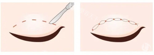 李淑薇医生割双眼皮超赞！经验充足+眼型设计个性化，术后双眼灵动无明显疤痕