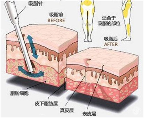 乌鲁木齐吸脂减肥哪里便宜？不同部位收费明细曝光，腰腹/大腿吸脂价格低至4500元