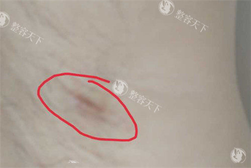 腋臭区域图