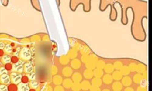 吸脂动画示意图