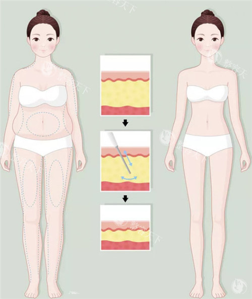吸脂前后动画图示