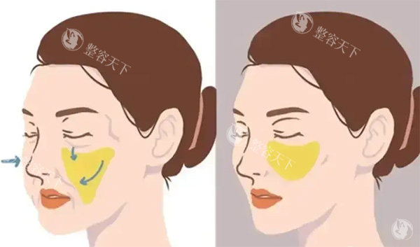 馒化脸脂肪移位照片