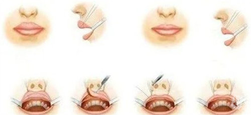 厚唇改薄