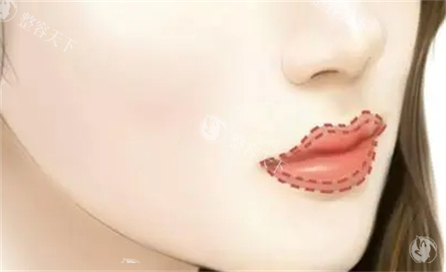 丰唇唇部画线填充图