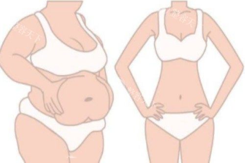 吸脂塑形前后对比图