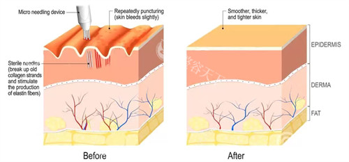凹陷性疤痕做什么比较好？医生推荐皮下分离+激光磨削，适合各种凹陷类型
