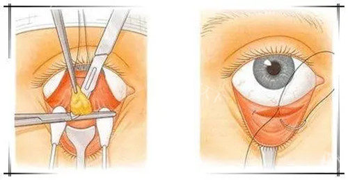 包头去眼袋全切哪个医生口碑好？韩俊祥|王玉林|孙武坚医生做全切眼袋技术口碑都好
