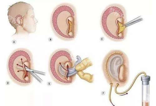 北京于晓波做小耳畸形矫正超特色！仿生度高形态自然，术后听力保护好，家长认可度高