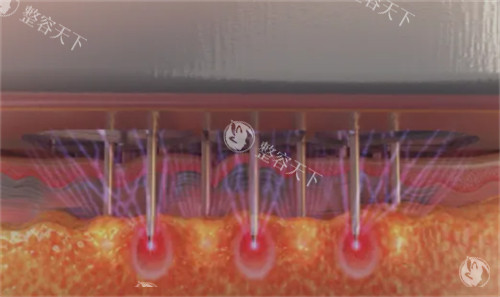 黑曜双波黄金微针怎么样