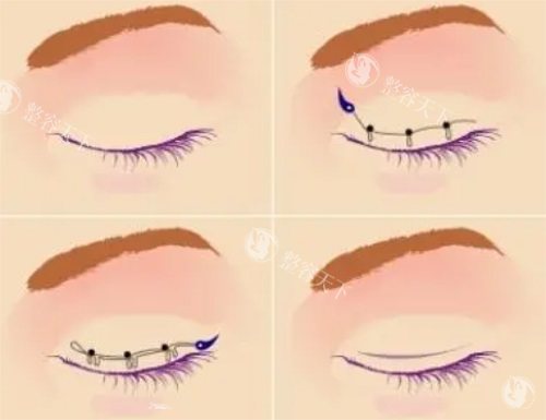 双眼皮手术示意图