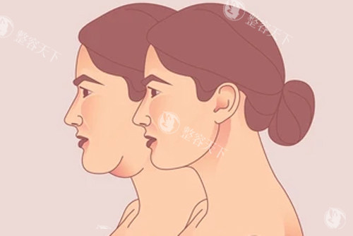 全脸拉皮7万贵吗？李晓东患者算的“十年抗衰账”，看完觉得值了