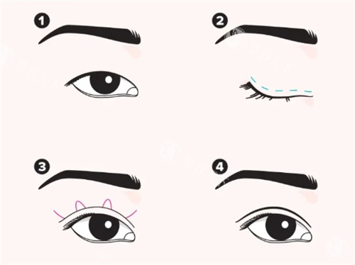 南京做双眼皮大概什么价格？2026埋线双眼皮3000元起、全切8000元起、眼综合15000元起~