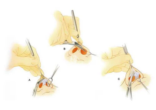 南京假体隆鼻价格是多少？硅胶假体隆鼻8000元起、膨体15000元起、超体12000元起
