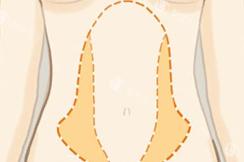 南京吸脂手术大概多少钱？面部吸脂8000元起、大腿吸脂10000元起、全身吸脂4万元起~