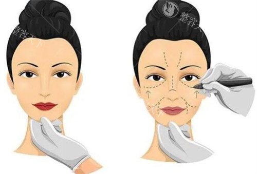 小拉皮手术过程