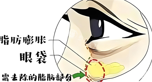 听说贺洁做眼袋毁了很多是真的吗？假的无隐形消费+技术透明，患者术后口碑反转打脸谣言