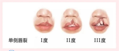 成都哪家医院能做兔唇修复手术？八大处整形、军建医院疤痕科、成都美容整形医院唇裂修复有名! 