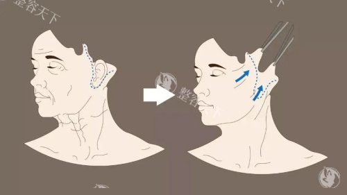 38岁宝妈亲测北京拉皮医生：从排行榜选了李晓东，7天拆线下颌线超清晰