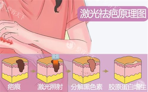 激光祛疤原理示图