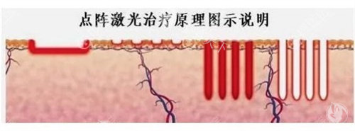 点阵激光祛疤