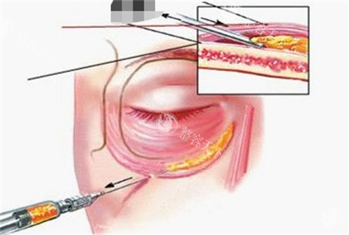 胶原蛋白注射眼部示意图