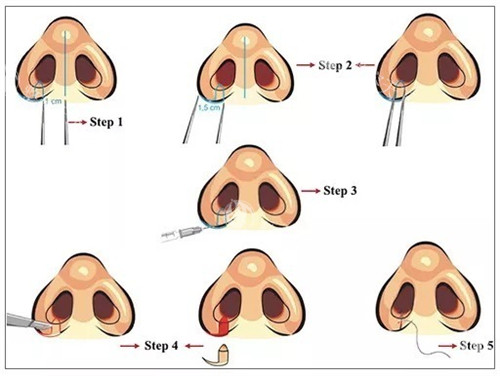 鼻翼缩小手术前后对比