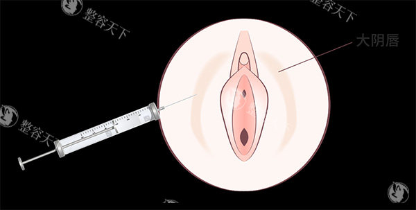 私密阴唇注射照片