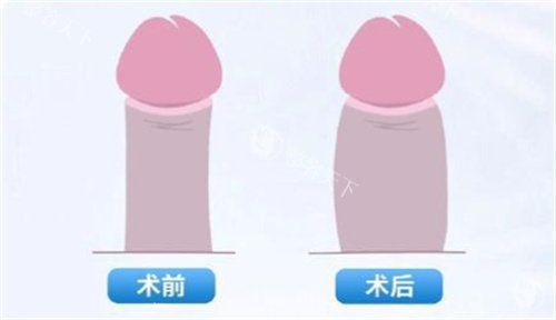 男性私密脂肪填充