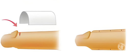 男性增粗手术示意图