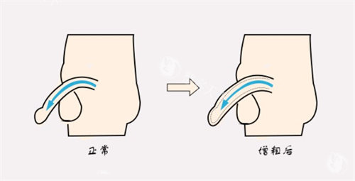 增粗术前后对比