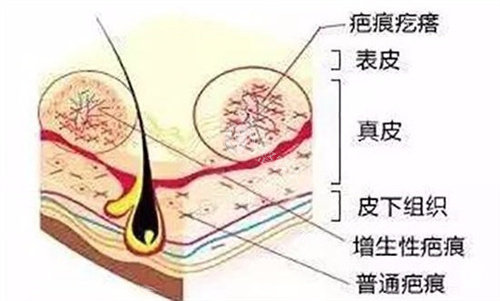 疤痕疙瘩皮肤解析图