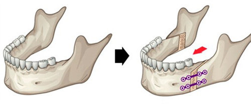 正颌术后恢复期到底有多难？术后 3 个艰难阶段真实分享，配合恢复技巧让过程更轻松！