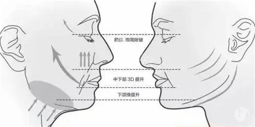 面部提升三大部位