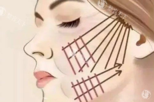 埋线提升卡通图片展示