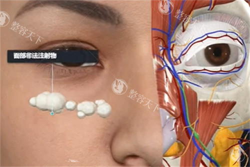 异物注射取出技巧